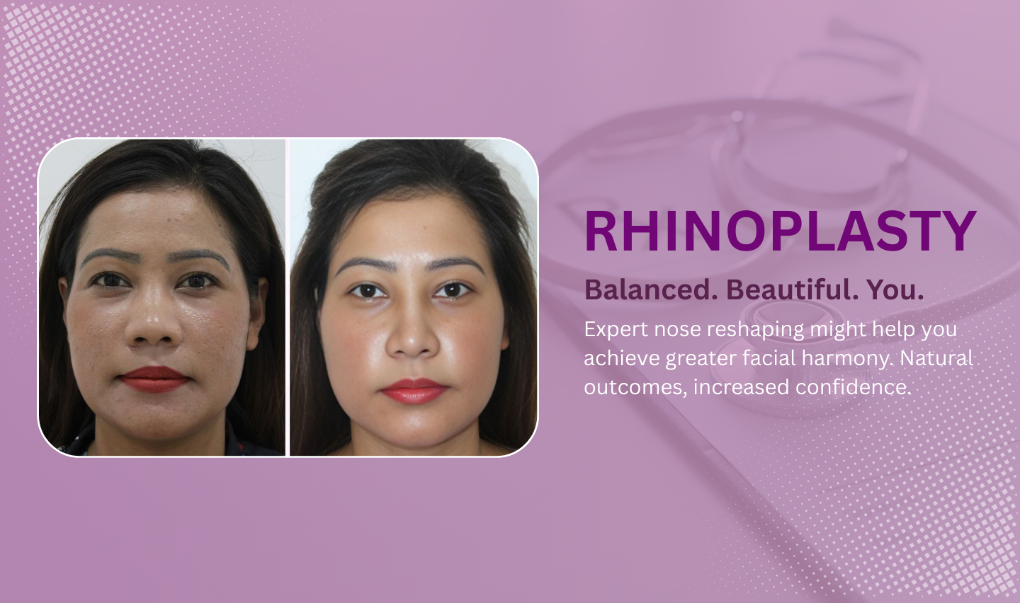 rhinoplasty