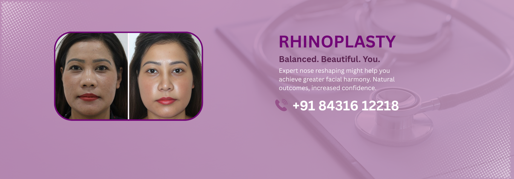 Rhinoplasty